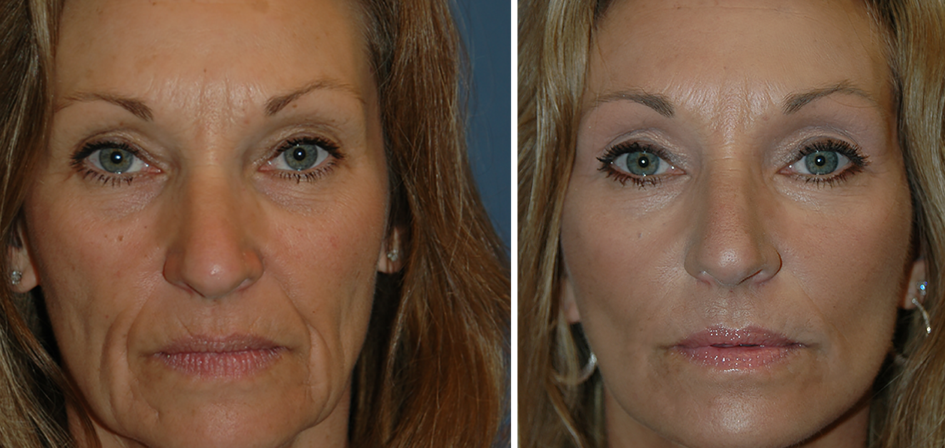 Facelift Recovery Timeline